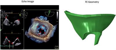 Mitral Valve Atlas for Artificial Intelligence Predictions of MitraClip Intervention Outcomes